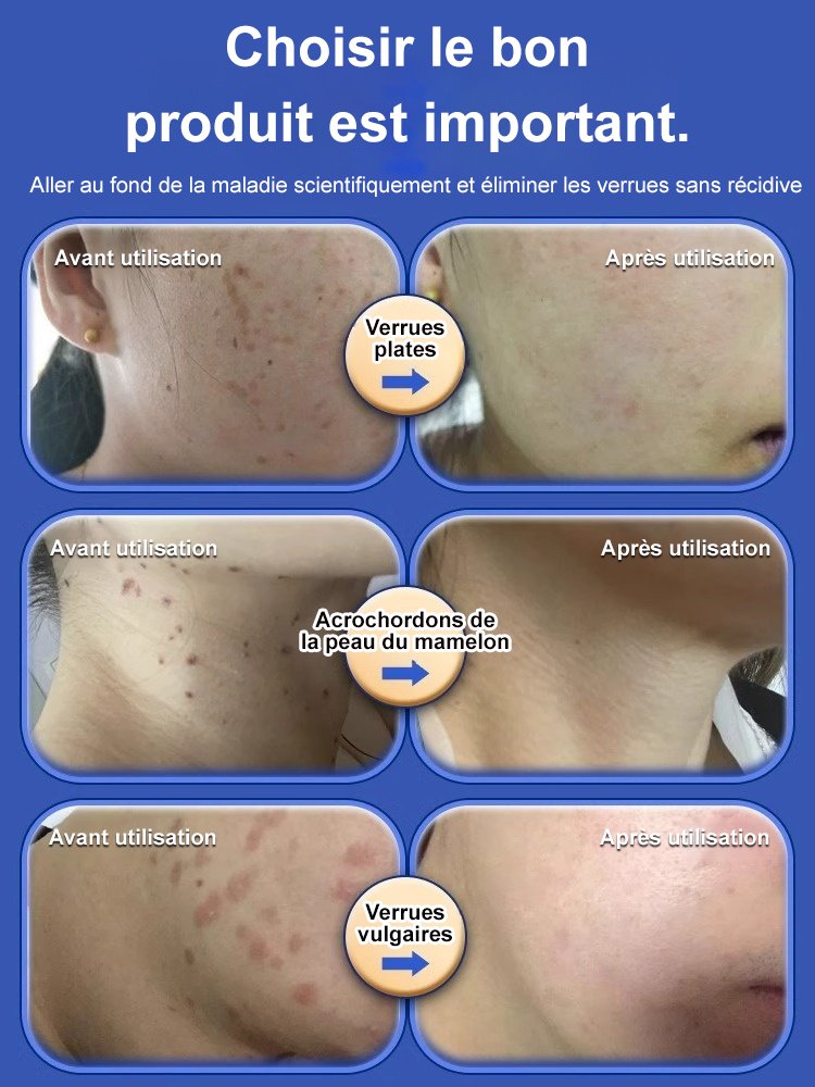 Antipyretic Verrucoqingning Medical Gel