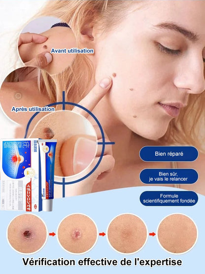 Antipyretic Verrucoqingning Medical Gel 